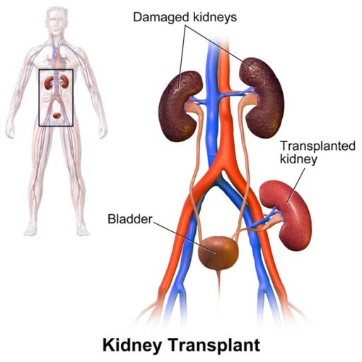 Kidney Failure & transplant