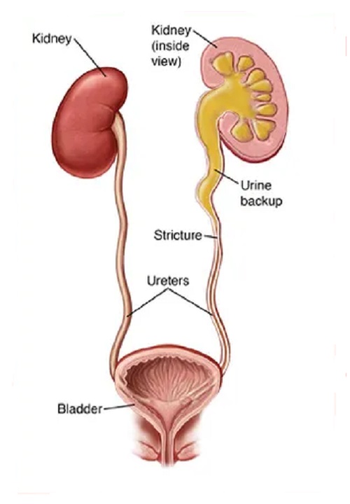 Stricture Urethra